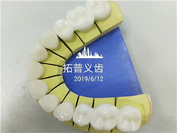 High Esthetics Zirconia Dental Lab Crowns Bridge With Layered Porcelain